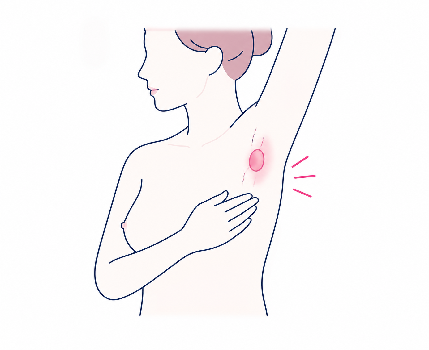 겨드랑이 멍울 의료 일러스트