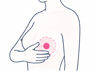 유방 멍울 의료 일러스트