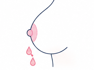 유두분비물 의료 일러스트